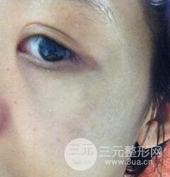 做了三次激光去太田痣，后來的果已經(jīng)是我較為滿意的了。