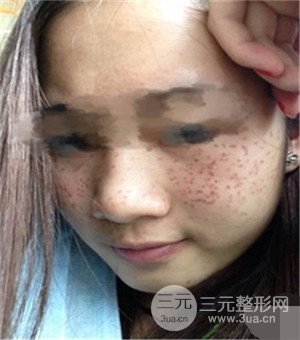 面部美白容整形激光祛斑手術(shù)恢復(fù)過程