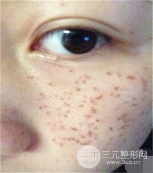 面部美白容整形激光祛斑手術(shù)恢復(fù)過程