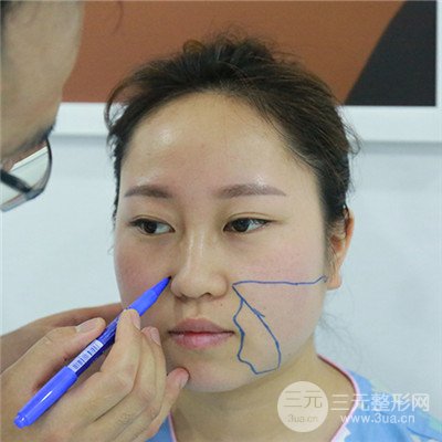 溫州友好醫(yī)院羅吉華光纖溶脂真人案例分享