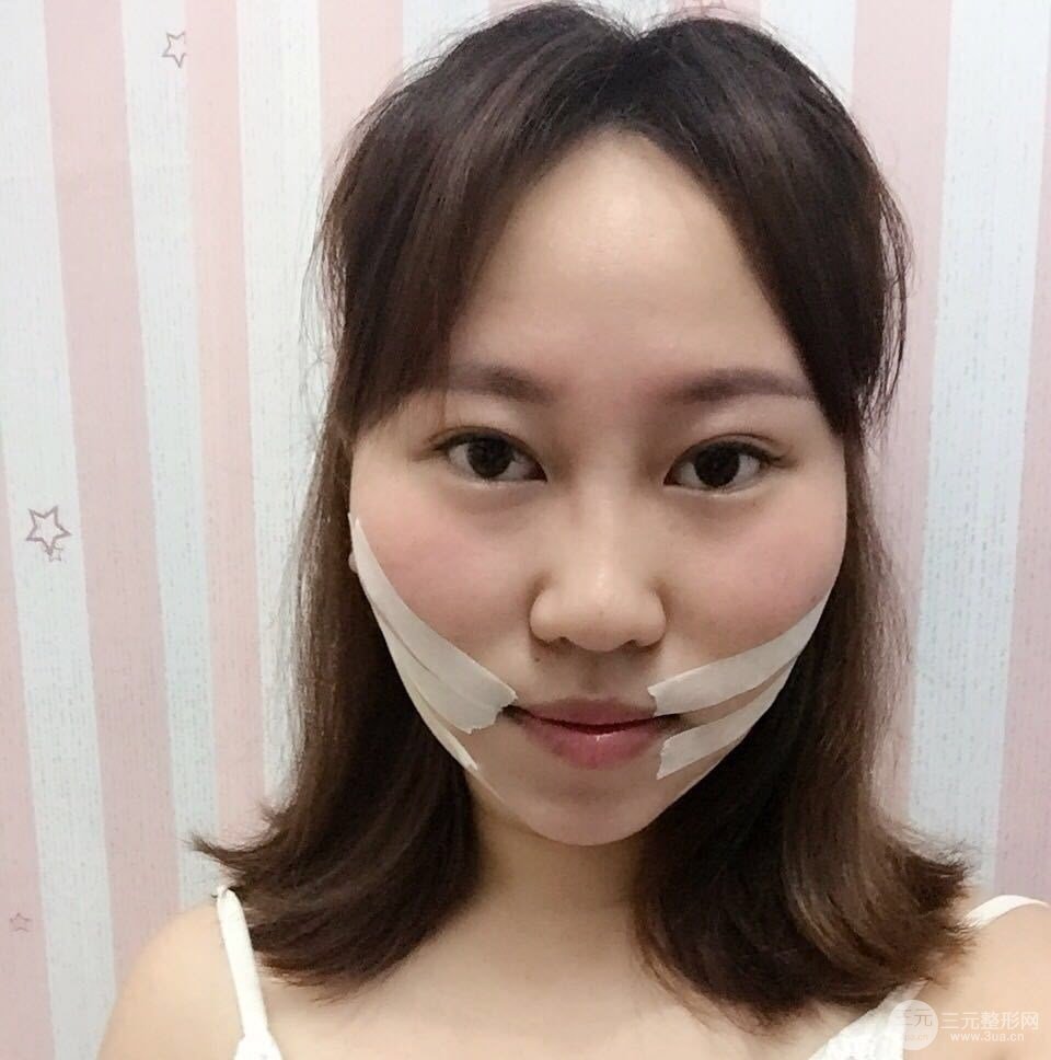 溫州友好醫(yī)院羅吉華光纖溶脂真人案例分享