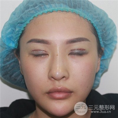 溫州友好醫(yī)院羅吉華眼部整形失敗修復(fù)真人案例分享