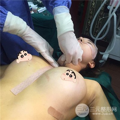 溫州友好醫(yī)院尹建祥自體脂肪隆胸真人案例分享