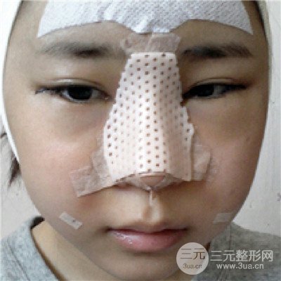 四川美萊牛永敢隆鼻整形三個月果照片分享~