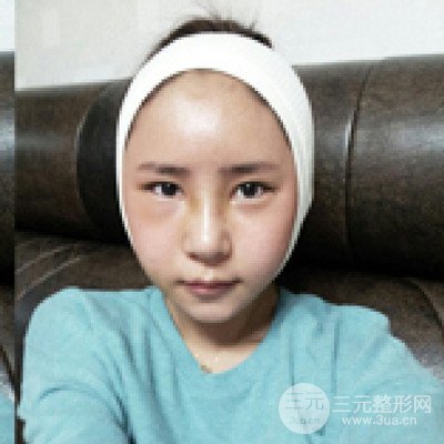 四川美萊牛永敢隆鼻整形三個月果照片分享~