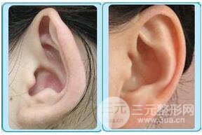 招風(fēng)耳矯正圖片，招風(fēng)耳矯正整形價格介紹