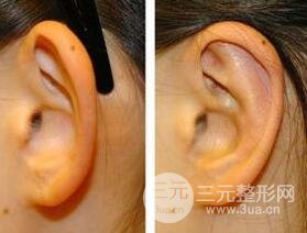 招風(fēng)耳矯正圖片，招風(fēng)耳矯正整形價格介紹