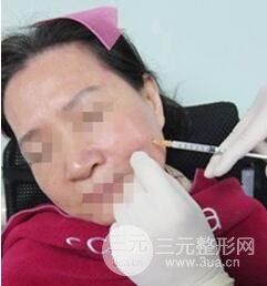 自從打了膠原蛋白除皺以后，都說(shuō)我年輕多了