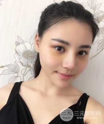 在漢中韓美做了隆鼻整形一個(gè)月，恢復(fù)越來越自然了