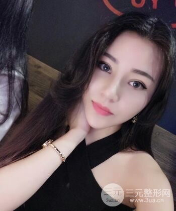 在漢中韓美做了隆鼻整形一個(gè)月，恢復(fù)越來越自然了