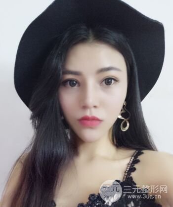 在漢中韓美做了隆鼻整形一個(gè)月，恢復(fù)越來越自然了
