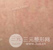 果酸換膚去妊娠紋真人案例和妊娠紋整形手術(shù)前后對(duì)比圖