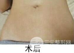 如何去除妊娠紋？做了果酸換膚去妊娠紋果不錯(cuò)，真人案例圖片分享