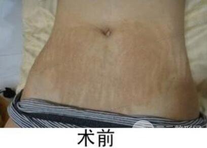 如何去除妊娠紋？做了果酸換膚去妊娠紋果不錯(cuò)，真人案例圖片分享