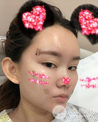 南昌永康自體脂肪面部填充兩個(gè)半月果圖