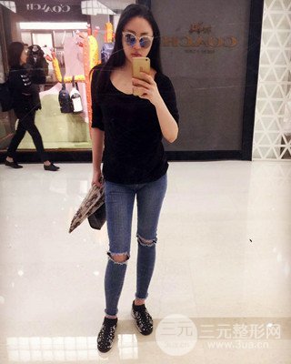 大腿吸脂前后對(duì)比照片，南昌永康王忠干真實(shí)案例分享