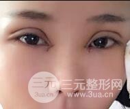 開內(nèi)眼角割雙眼皮案例介紹和恢復(fù)過程圖