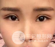 開內(nèi)眼角割雙眼皮案例介紹和恢復(fù)過程圖
