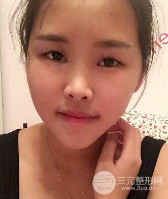 開內(nèi)眼角割雙眼皮案例介紹和恢復(fù)過程圖