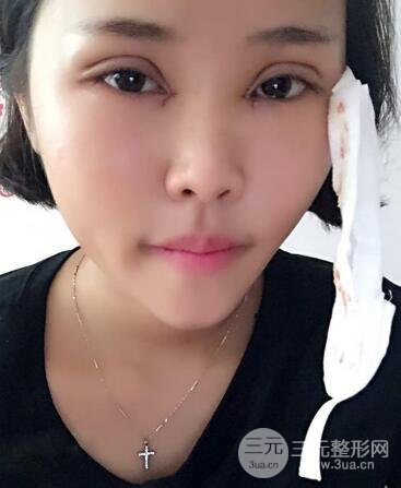 開內(nèi)眼角割雙眼皮案例介紹和恢復(fù)過程圖
