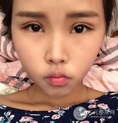 開內(nèi)眼角割雙眼皮案例介紹和恢復(fù)過程圖