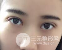 埋線雙眼皮真人案例和十天恢復(fù)圖片日記