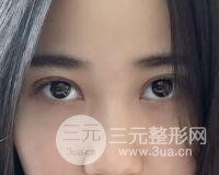 埋線雙眼皮真人案例和十天恢復(fù)圖片日記