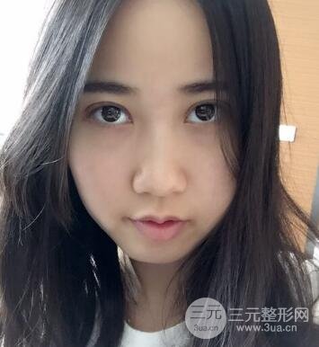 埋線雙眼皮真人案例和十天恢復(fù)圖片日記