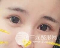 割雙眼皮六個月恢復過程圖片和真實案例