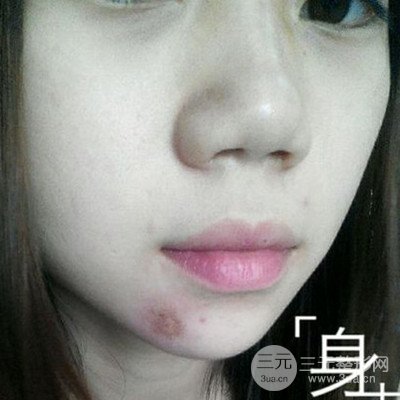 濟(jì)南曹博士魯開化激光祛疤真人案例分享