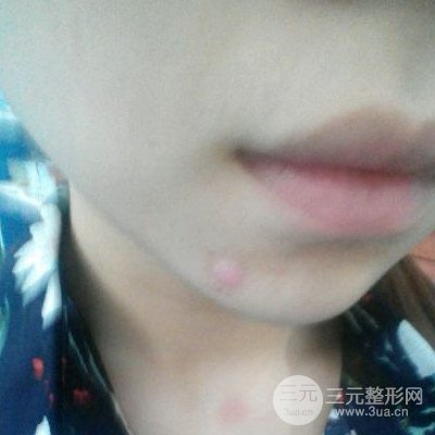 濟(jì)南曹博士魯開化激光祛疤真人案例分享