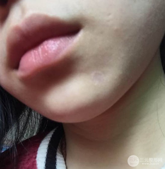 濟(jì)南曹博士魯開化激光祛疤真人案例分享