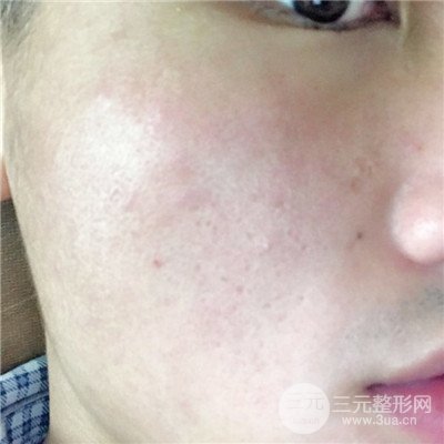 濟(jì)南曹博士魯開化祛痘坑痘印真人案例分享