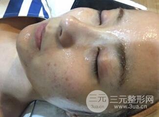 水光補水嫩膚果圖前后對比和恢復過程真實案例分享