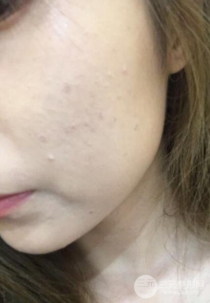 水光補水嫩膚果圖前后對比和恢復過程真實案例分享