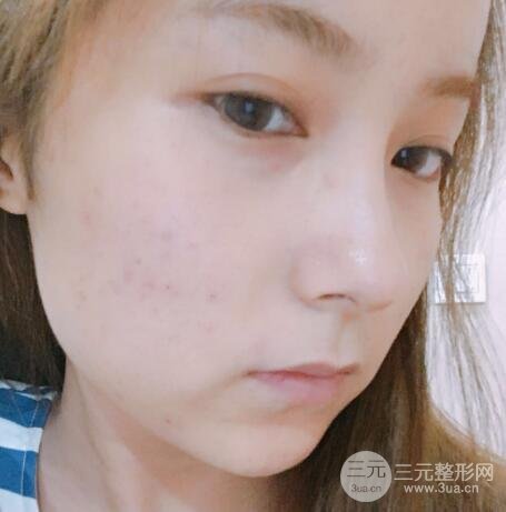 水光補水嫩膚果圖前后對比和恢復過程真實案例分享