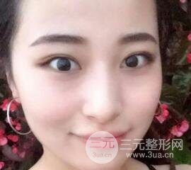 痘坑痘疤要怎么修復(fù)？果酸換膚后臉果圖和真實(shí)案例分享