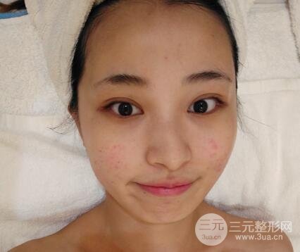 痘坑痘疤要怎么修復(fù)？果酸換膚后臉果圖和真實(shí)案例分享