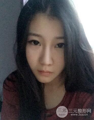 長(zhǎng)沙鵬愛(ài)隆鼻整形果展示 恢復(fù)過(guò)程圖