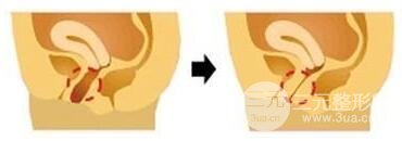 女性陰道緊縮術(shù)需要多少錢?