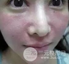 我做了光子嫩膚幾天起而且價格便宜前后對比照片案例