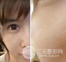 我做了光子嫩膚幾天起而且價格便宜前后對比照片案例