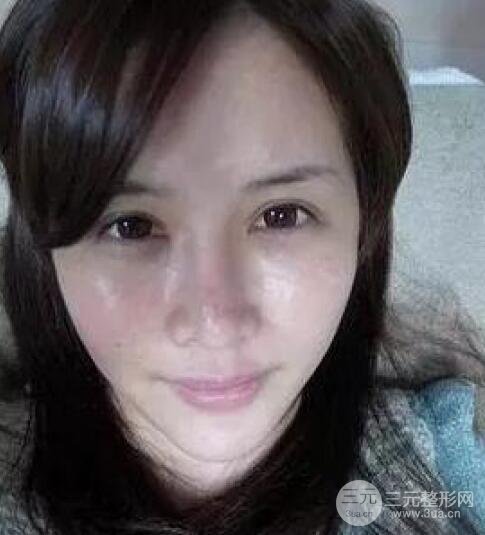 我做了光子嫩膚幾天起而且價格便宜前后對比照片案例