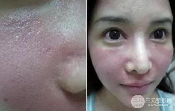 我做了光子嫩膚幾天起而且價格便宜前后對比照片案例