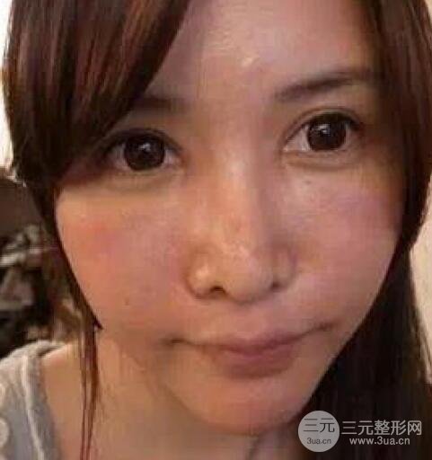 我做了光子嫩膚幾天起而且價格便宜前后對比照片案例