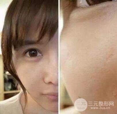 我做了光子嫩膚幾天起而且價格便宜前后對比照片案例