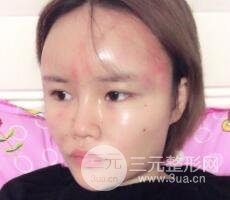 全臉脂肪填充價格 恢復過程圖 真實案例分享