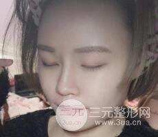 全臉脂肪填充價格 恢復過程圖 真實案例分享