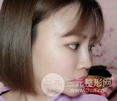 全臉脂肪填充價格 恢復過程圖 真實案例分享