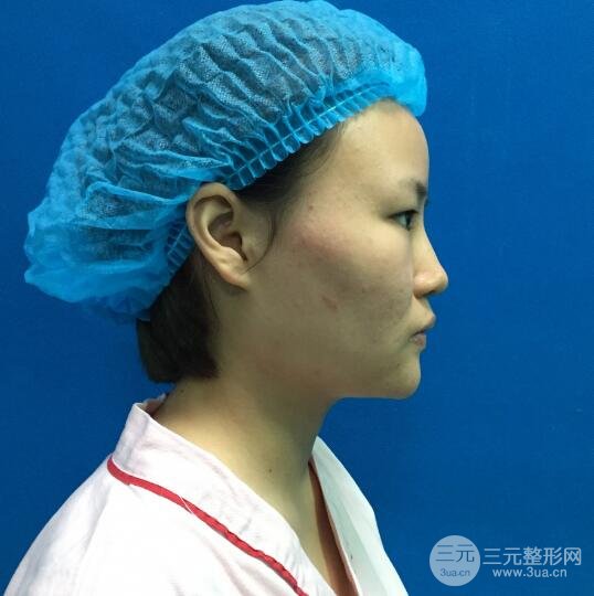 全臉脂肪填充價(jià)格 恢復(fù)過程圖 真實(shí)案例分享